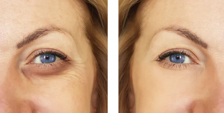 Intense Eye Revive (mtl 2) - Image 5
